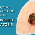 treatment for seborrheic keratosis