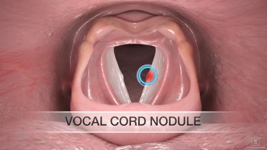 Vocal Cord Nodules treatment and everything