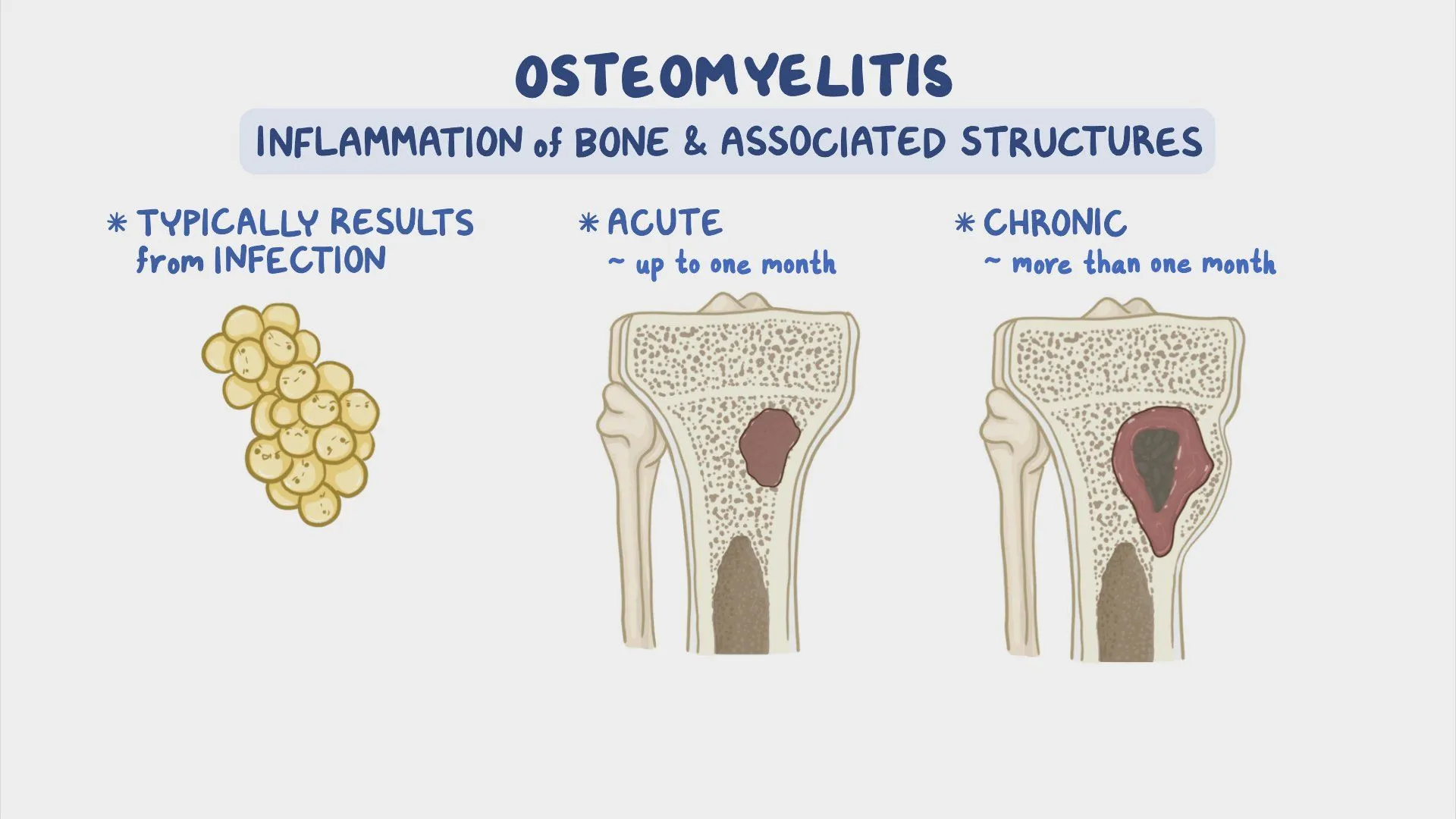 What Is Osteomyelitis, And What Are The Symptoms?